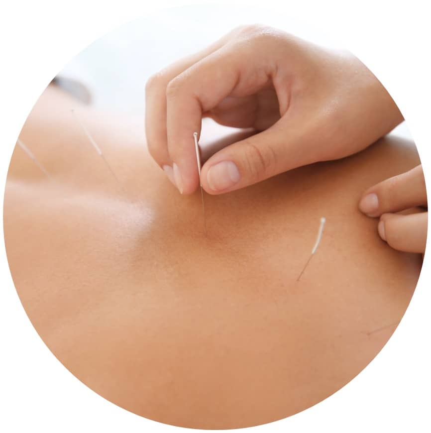 acupuncture needles - what can i expect photo